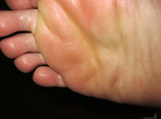 也会导致脚底部位出现大量的胆红素堆积在脚底部位,导致脚底发黄