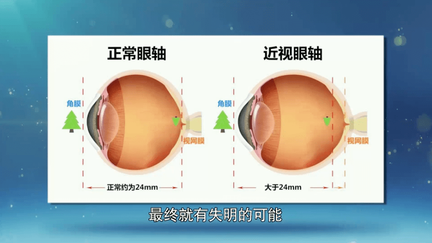 科普龙江 | 眼科专家透露真相：近视手术不能治愈近视！