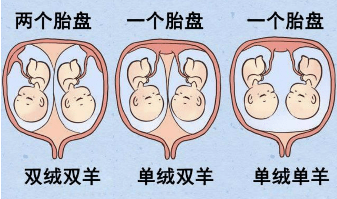 单绒毛膜囊双胎图片