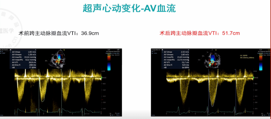 心讲座|朱天刚:pr显著延长合并qrs波增宽的心衰——crt治疗显奇效_左
