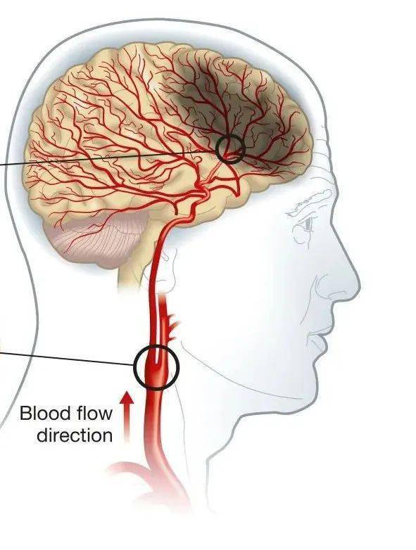脑梗位置图片图片