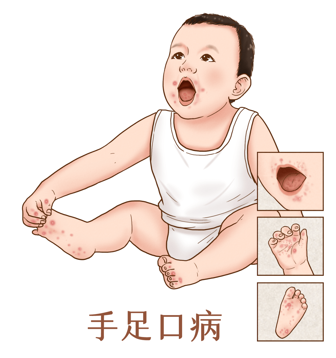 手足口病初期嘴巴图片及症状（手足口病会有哪些表现？） | 说明书网