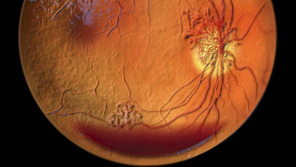 这五种并发症 都是高度近视引起的 家长知道吗?_视网膜_危害_变性