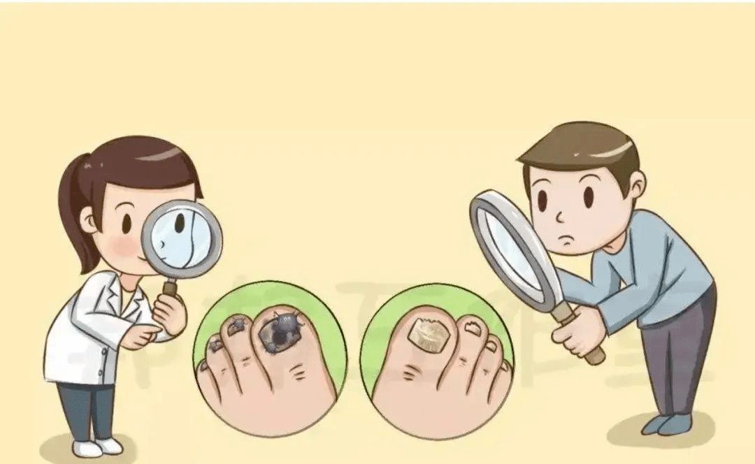 【医文医话】世界银屑病日:如何区分灰指甲与银屑病甲?