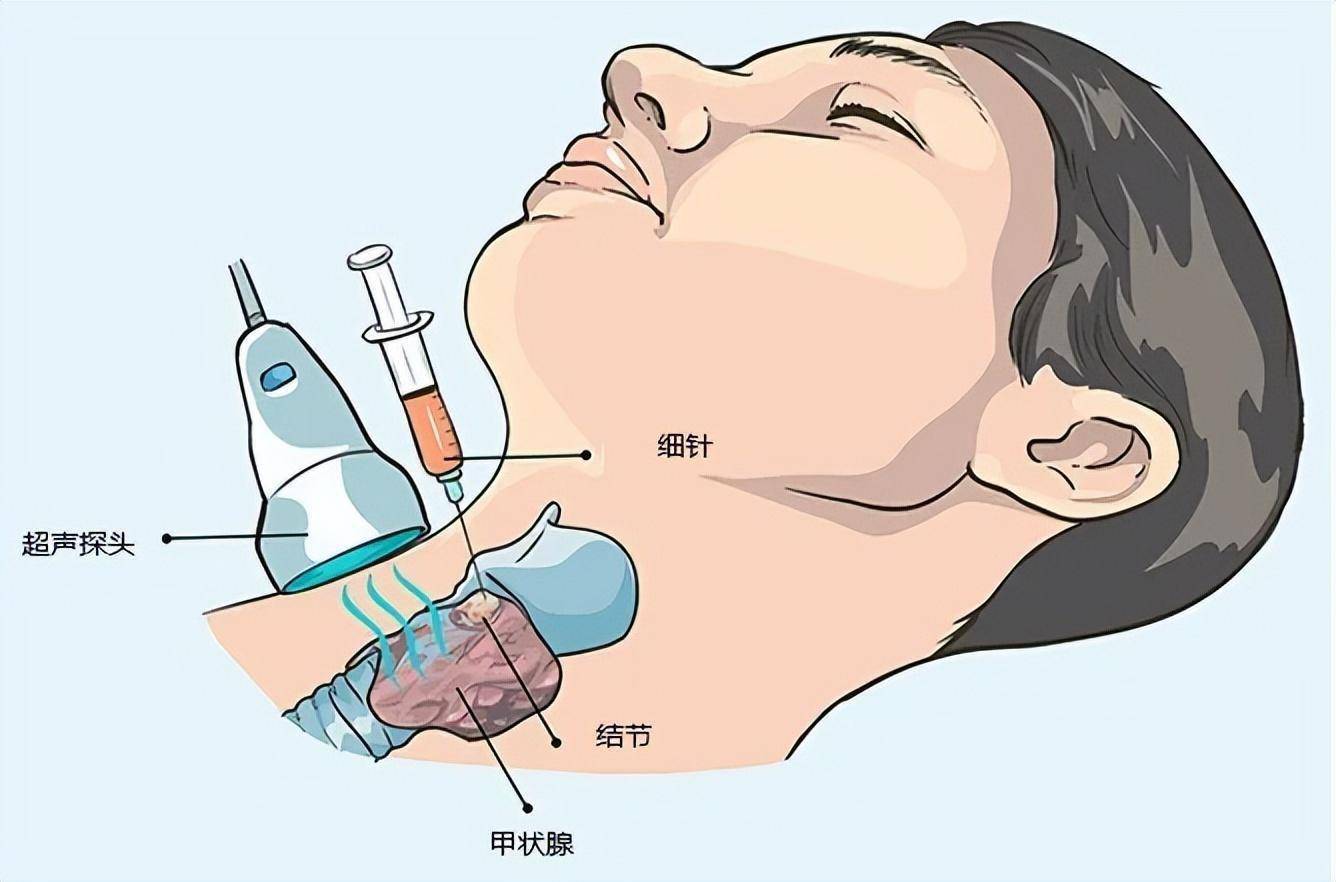 甲状腺结节动漫图片图片