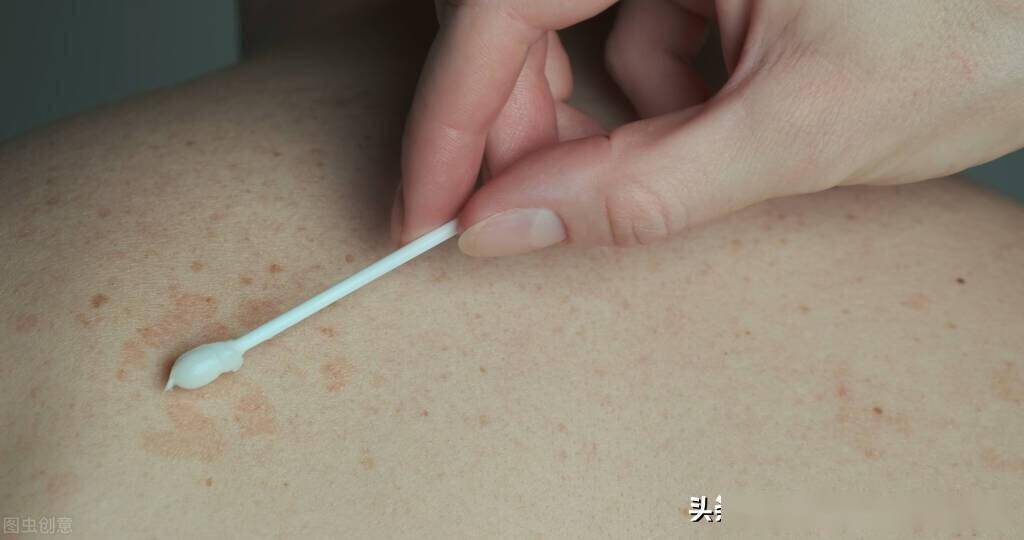 多磺酸粘多糖乳膏毁容图片