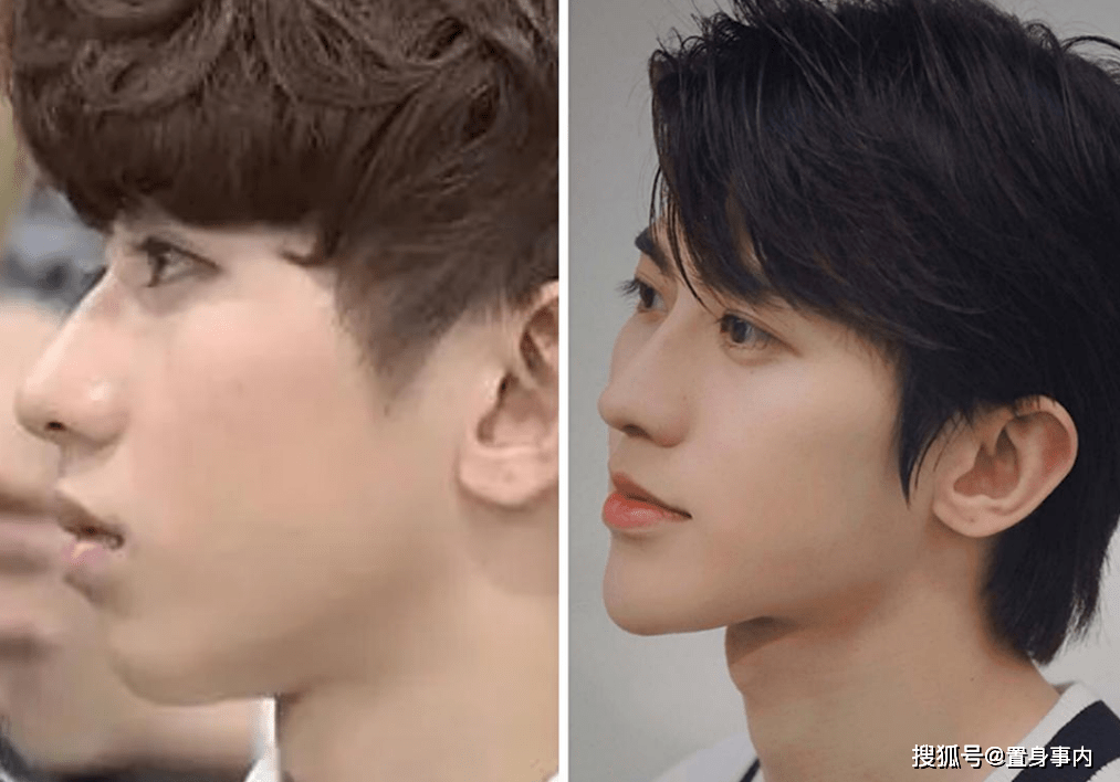 蔡徐坤就比较聪明地选择了用垫下巴和打针,来改变自己的脸型,感觉不