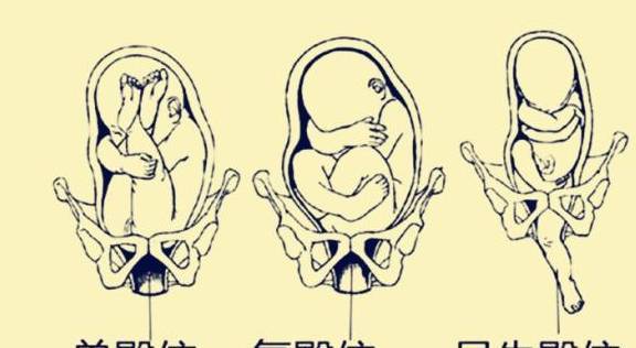 宝妈一直左侧睡,但是宝宝还是臀位,怎么办?_胎儿_胎位_孕妇