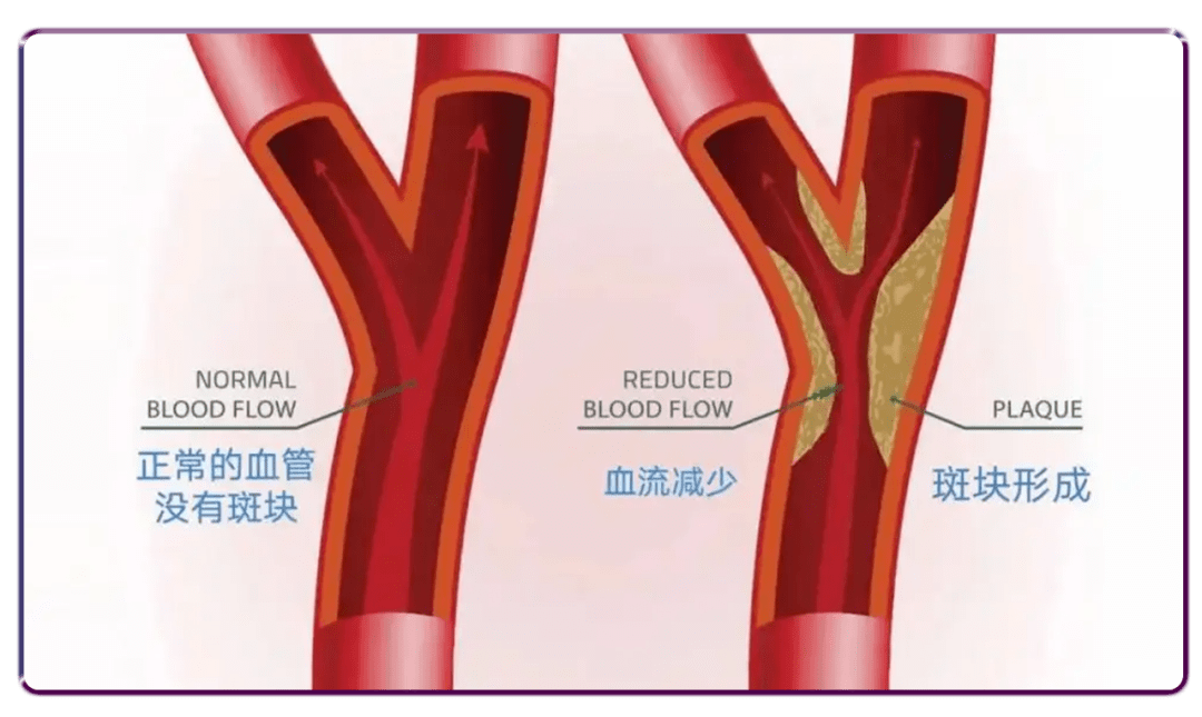 无线掌超将成为「颈动脉斑块超声早筛」常规工具_血管_血流_缺血性