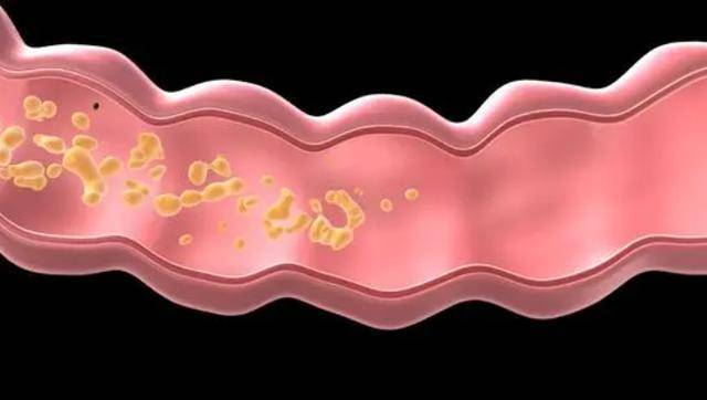 大便情況長期無法改善,醫生提醒:可能是這三種疾病76腸息肉如果你