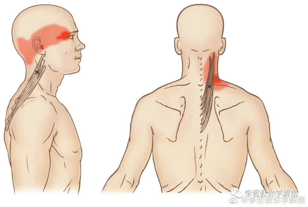 头半棘肌(图7),会造成太阳穴的地方疼痛,许多客户会当成偏头痛,其实是