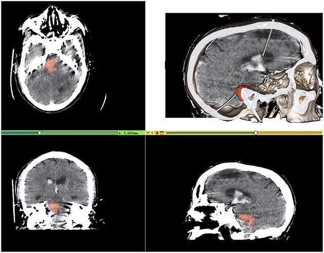 脑干出血ct图片