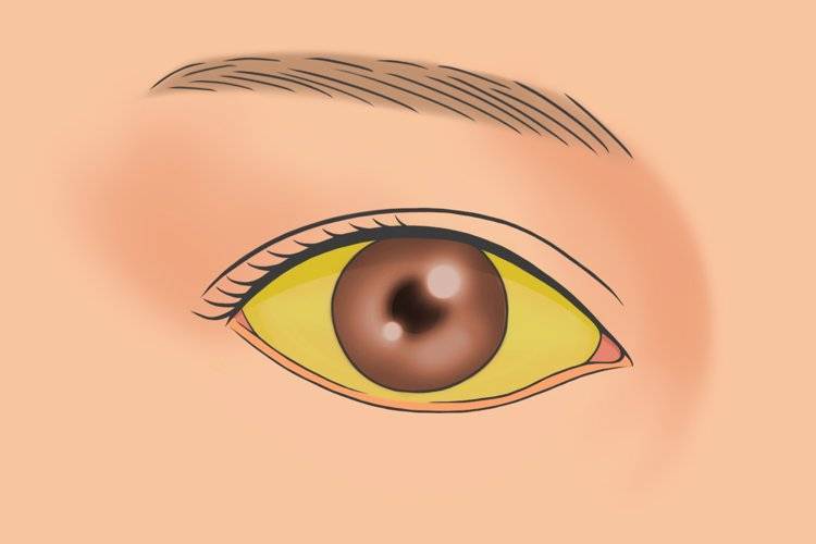 胆囊癌可引起各种胆管内组织病变,从而造成有黄疸现象,身体皮肤,眼睛