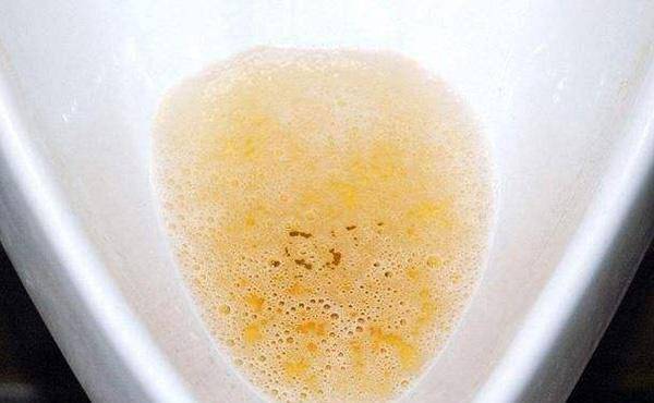 早上起来排尿的时候,就会发现原本应该是清澈透明,淡黄色的尿液,却