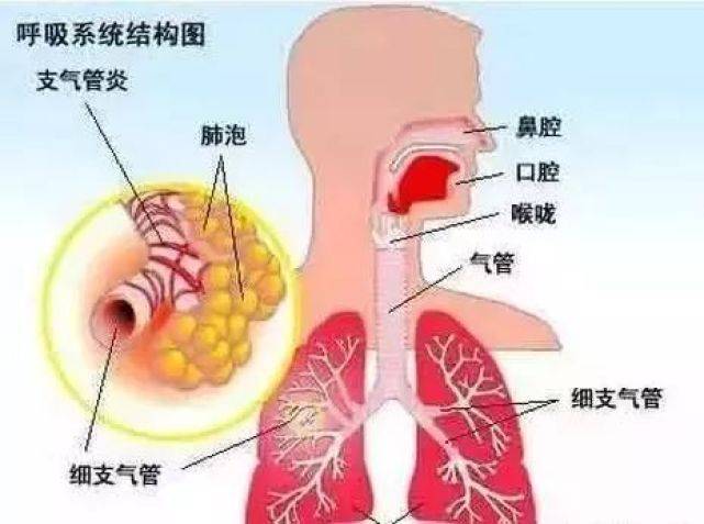 患有毛细支气管炎有什么症状(如何治疗及预防)