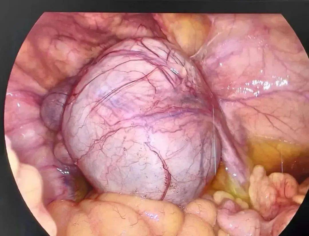 妇科囊肿图片 b超图片