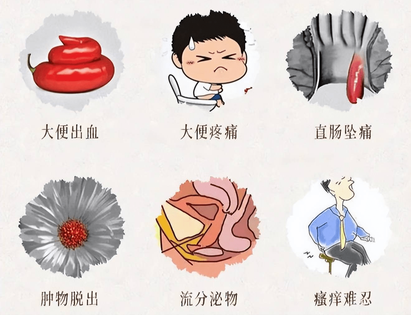 治疗痔疮的三大原则_症状_肛门_生活