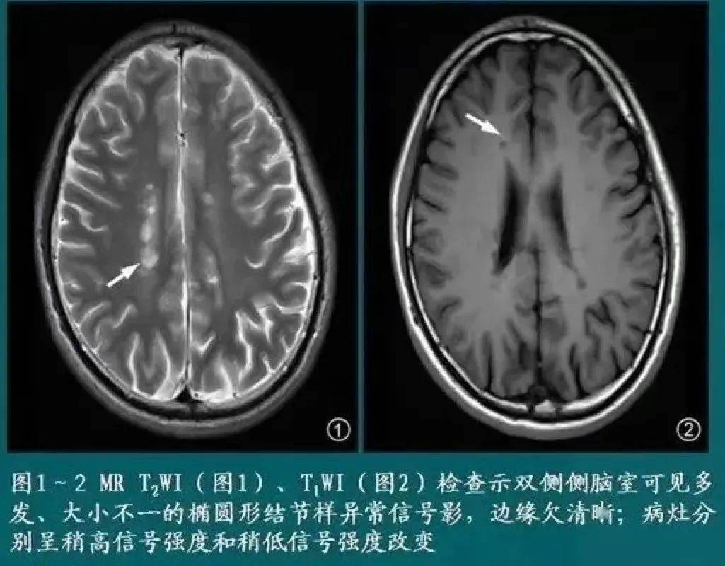 头颅 MRI 不会看？DWI、T1、T2......这篇讲清楚了！_成像_信号_序列