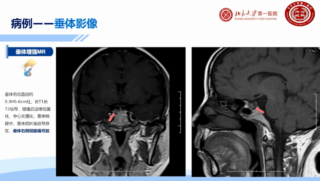 6 cm病灶,增强后边缘强化,中心无强化,垂体柄居中,垂体后叶高信号存在