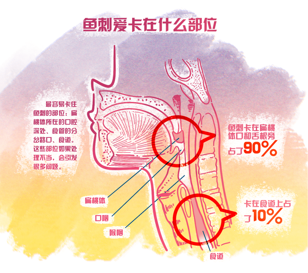 鱼刺通常容易卡住宝宝的扁桃体所在的口腔深处