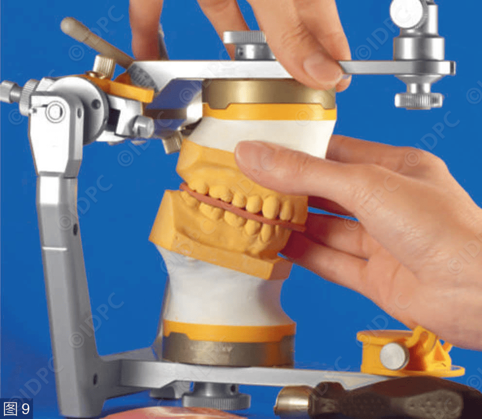 【精选案例】学系列 | 分析与咬合重建中的颌架应用(德)_检查_测试