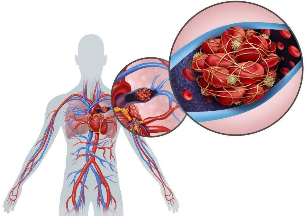 什么是瘀血?瘀血是指死的血或堆积在毛细血管上不流动的血.