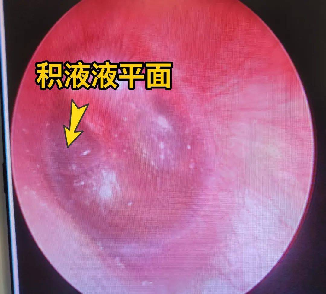 耳朵积液穿刺手术图解图片