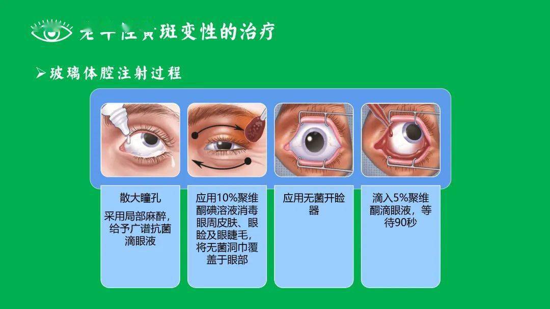 保护眼底黄斑,维护视力健康②——常见黄斑病变的分类及治疗健康大