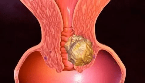宫颈炎发展到宫颈癌图片