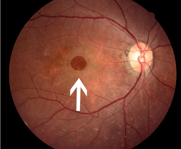 视网膜黄斑中心凹图片图片