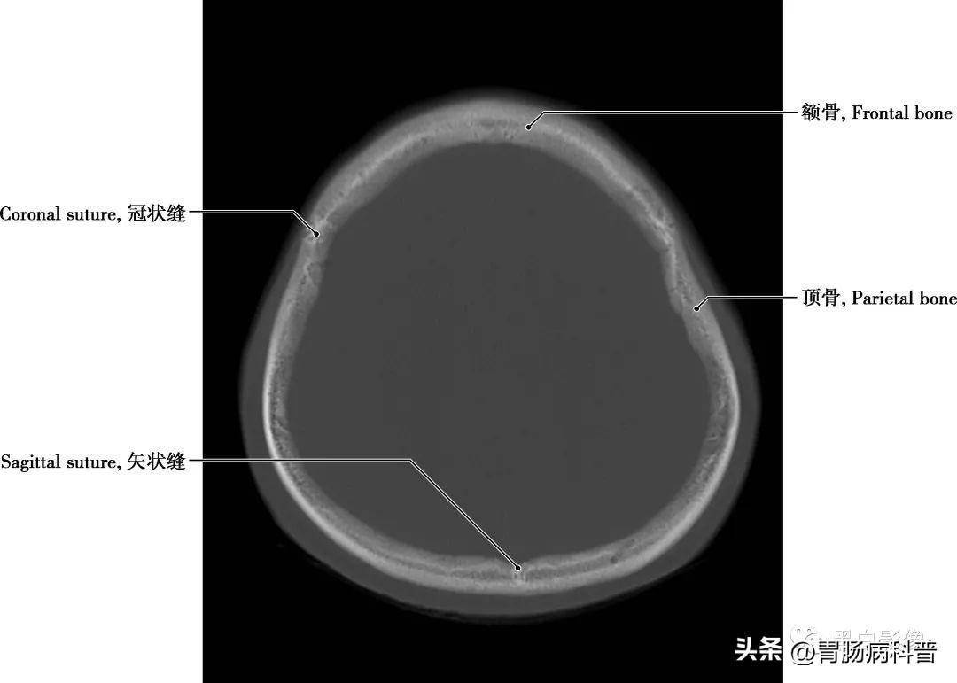 圖1-2-5 經半卵圓中心軸位切面矢狀縫 兩頂骨之間所成的縫隙,呈矢狀位