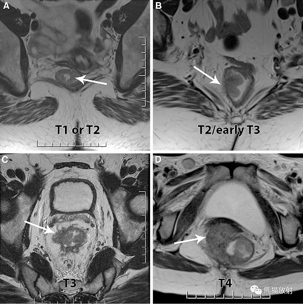 直腸癌mri:精彩示例,易學易懂_括約肌_腸繫膜_腹膜