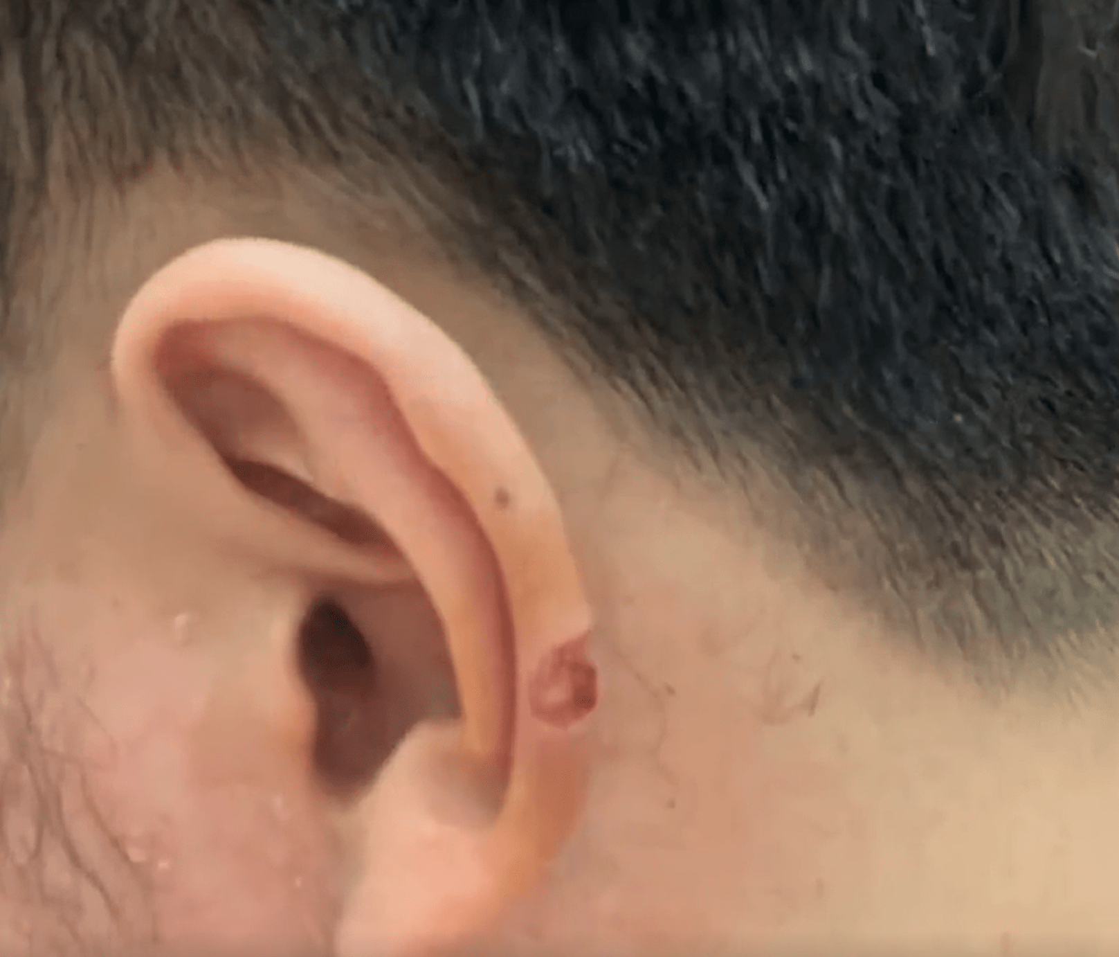 耳朵上有这条折痕，是心梗、猝死的“标志”？听听专家怎么说_耳垂
