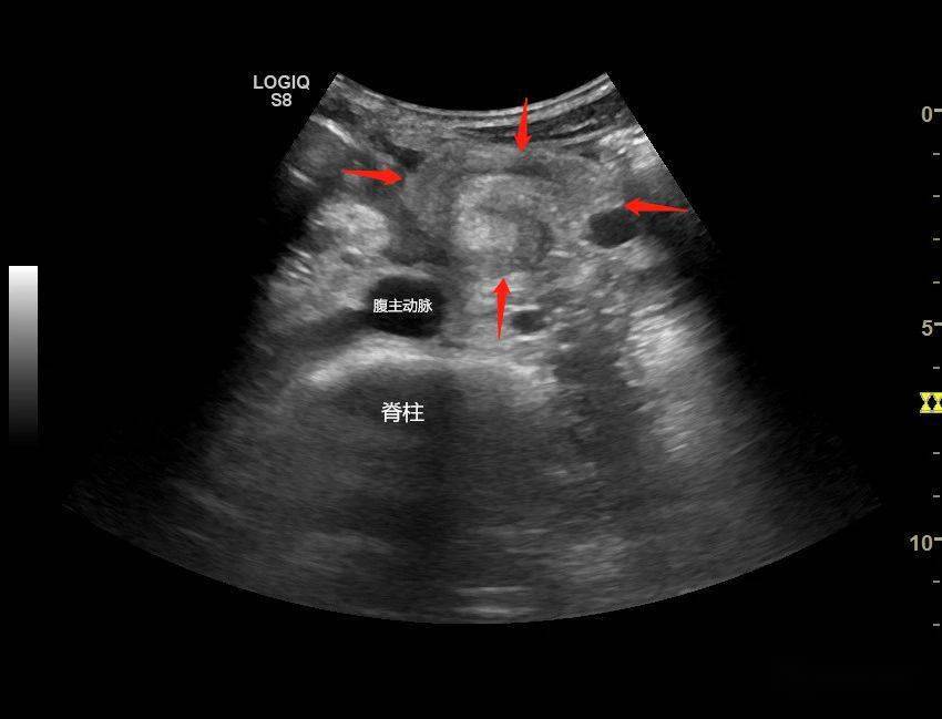 「漩涡征」:超声诊断小肠扭转的线索_肠系膜_主动脉_静脉