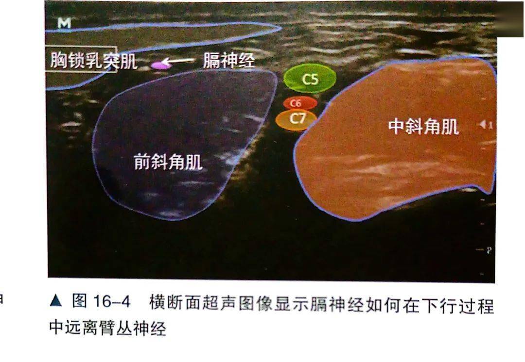 肌间沟麻醉定位图片图片