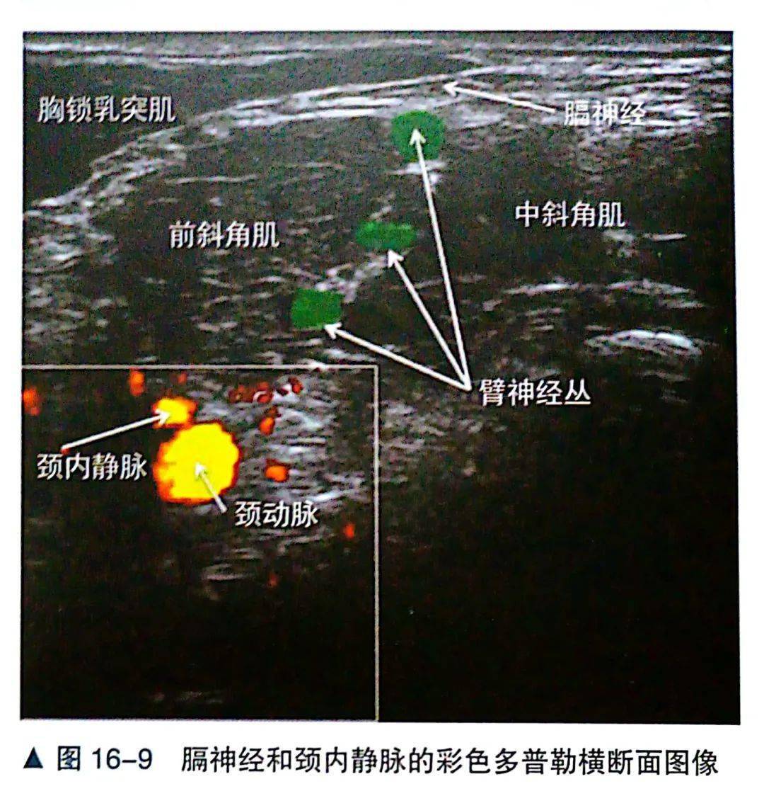 肌间沟臂丛麻醉,为什么最容易导致膈神经麻痹?