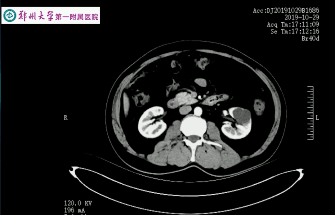手术演示丨后腹腔镜下左肾腹侧肾门部复杂囊肿切除术