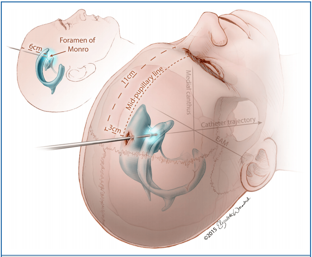 kochers点经额角到达侧脑室,用途广泛01part前方入路组壹