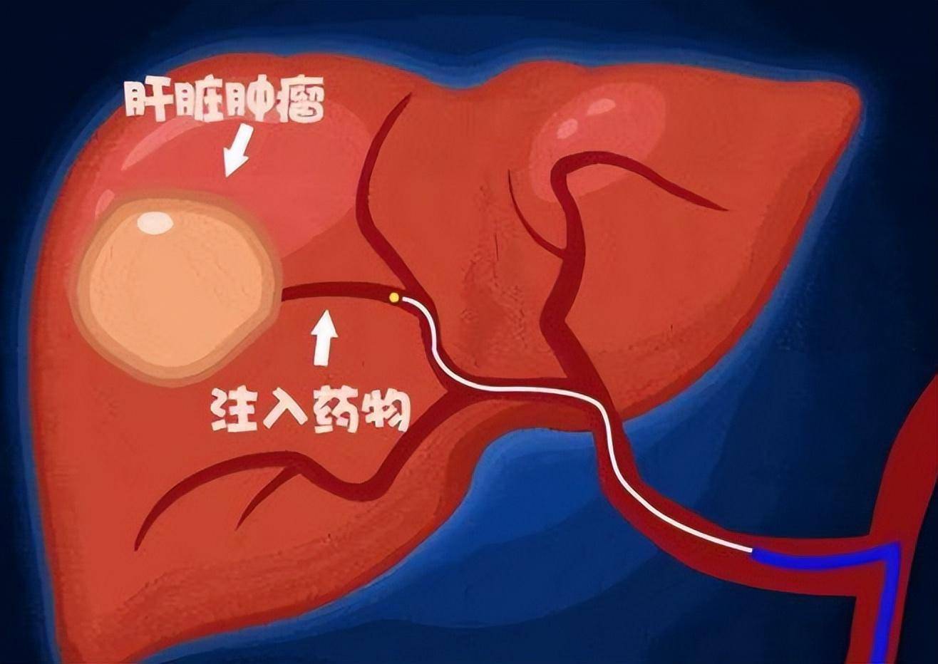 56岁江苏大叔患肝癌,一个月后癌细胞被饿死,到底发生了什么