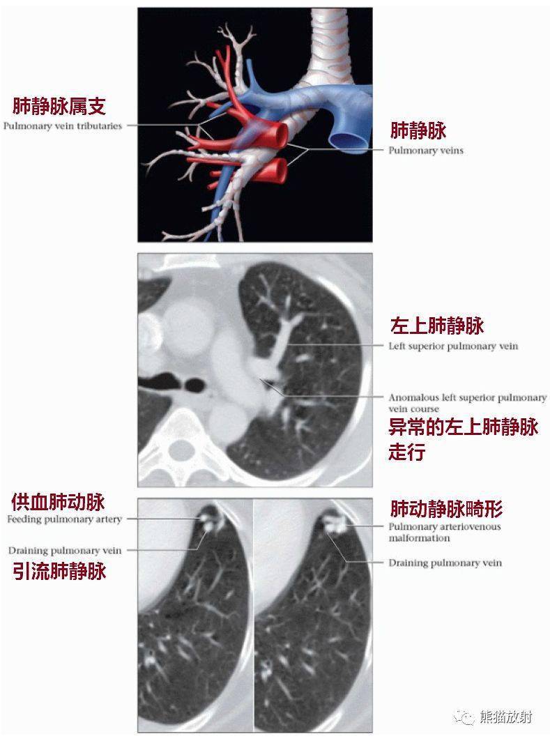 右肺静脉图片