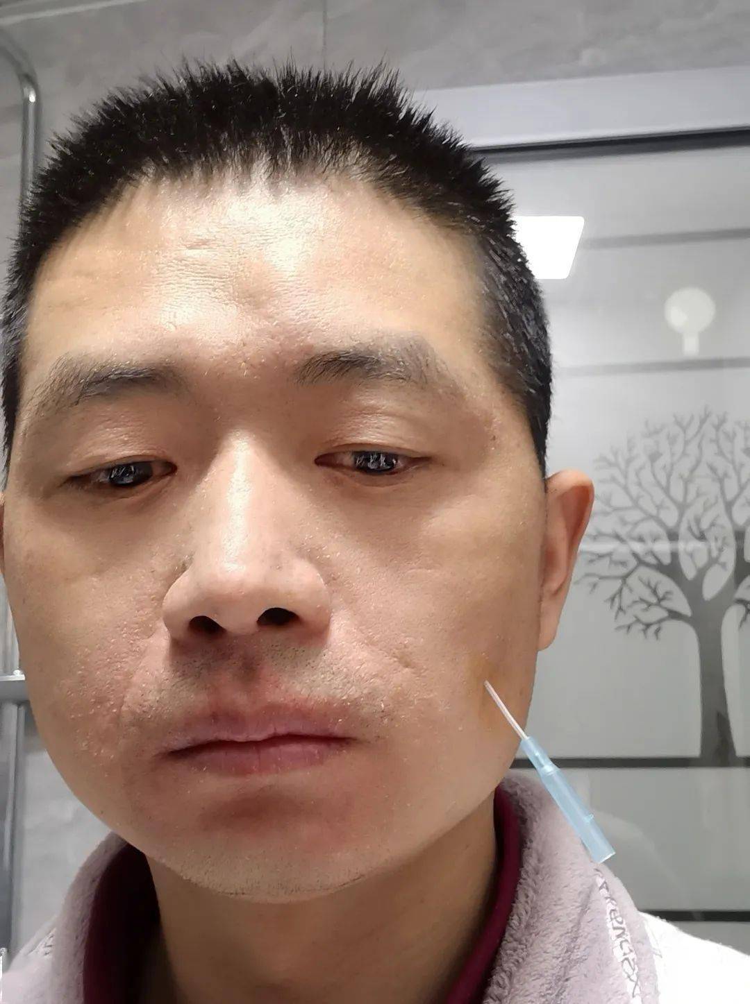 没有人帮我,只能对着镜子自己来,一番操作后嘴歪,鼓腮漏气,流口水等