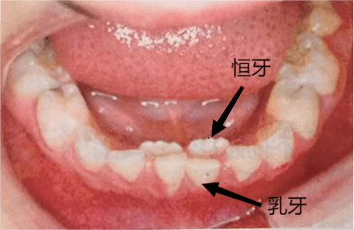 乳牙滞留图片怎么办图片