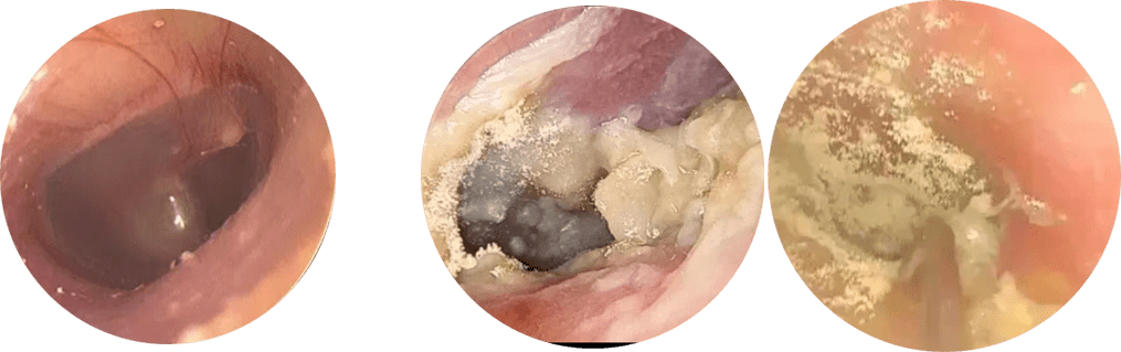 外耳道炎治疗方法图片