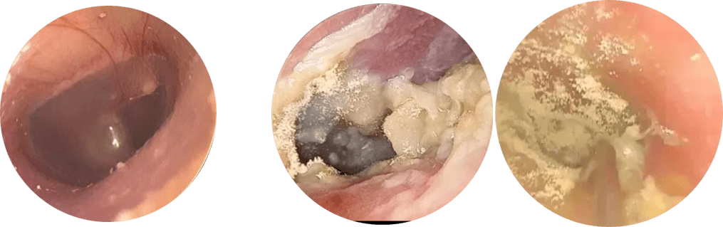 外耳道白色分泌物图片
