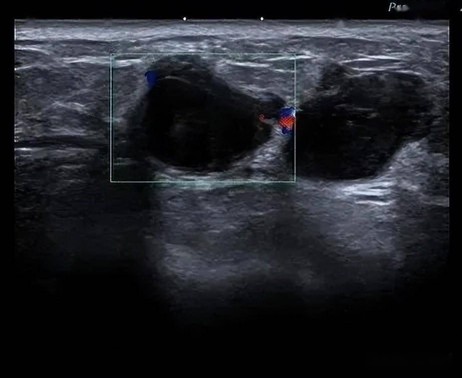 乳腺结节4c图片