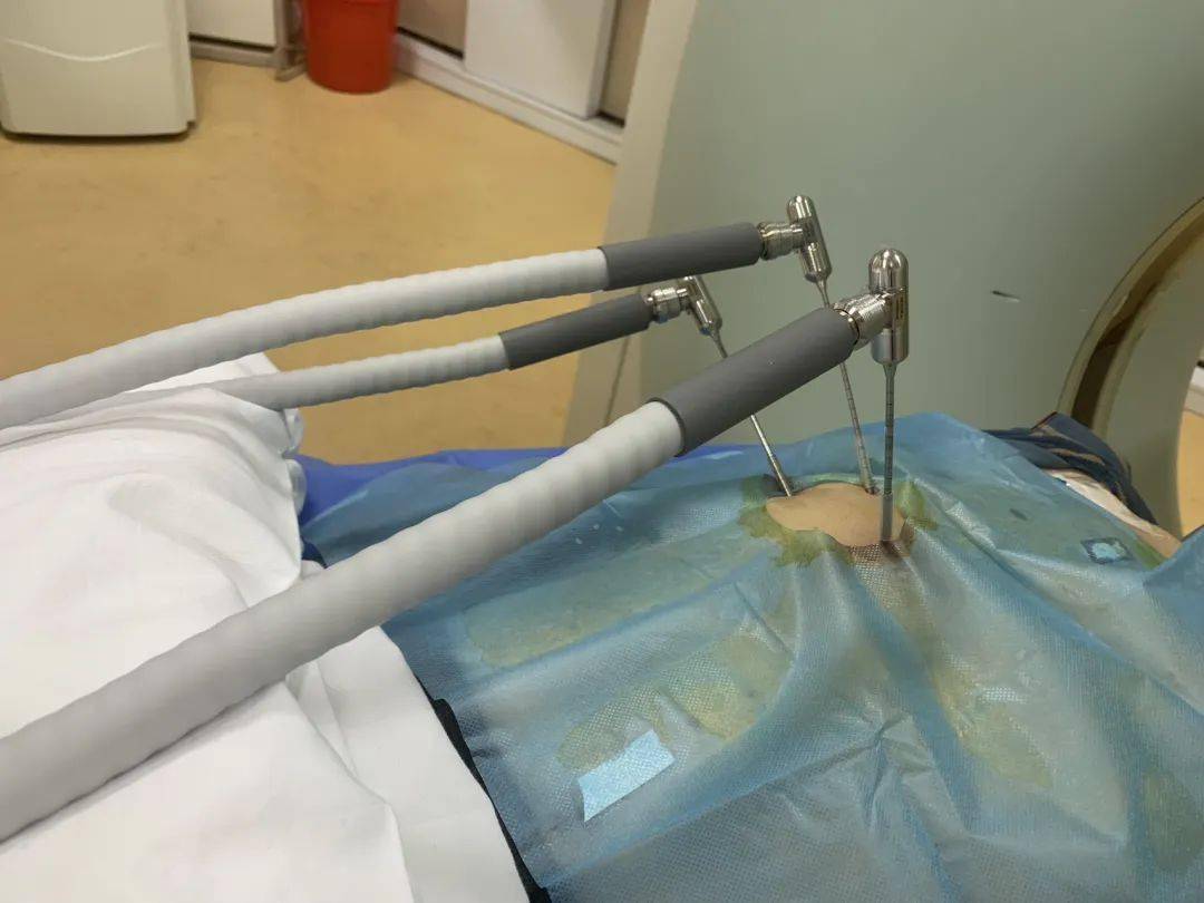 康博刀冷冻消融术——将癌细胞按下"暂停键"_刘先生_恶性肿瘤_治疗