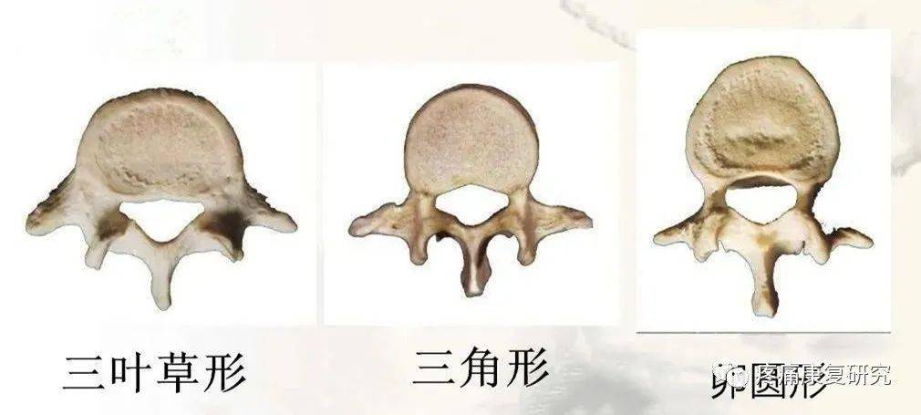 侧隐窝狭窄的相关解剖、神经卡压及其症状、诊断和治疗_关节_腰椎_间隙