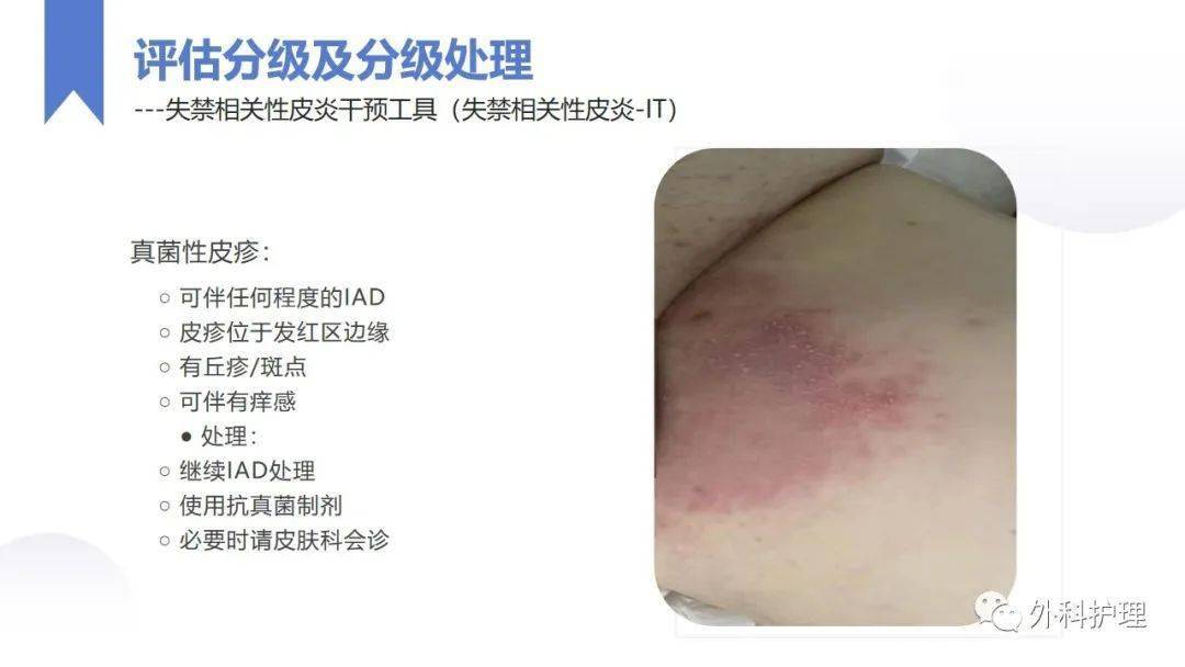 【ppt】失禁性皮炎的护理_直播_微信_管理