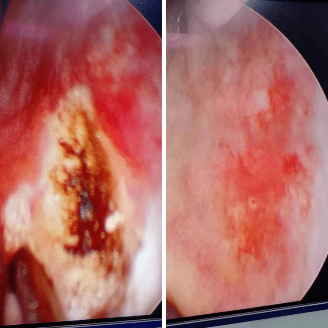 精准,快速,有效的堵住患者鼻腔的出血点是治疗鼻出血的关键