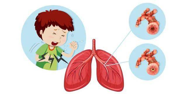 科普 告别小儿支气管炎 家庭护理是关键